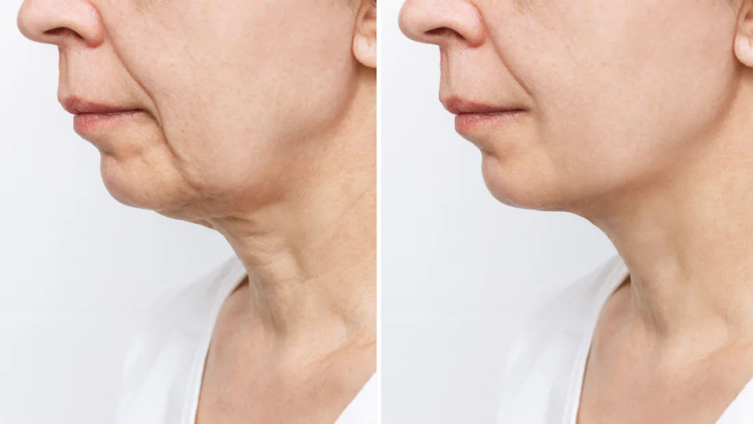 Illustrative side views of a jaw and neck, before and after.